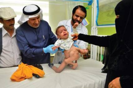 طفل يمني يغادر مستشفى الملك عبدالله بعد التخلص من توأمه الطفيلي
