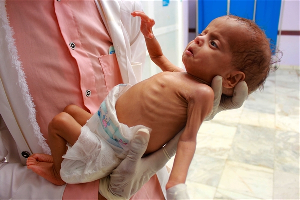 مليشيا الحوثي تعترف بتفشي شلل الأطفال وتعرقل حملات التطعيم
