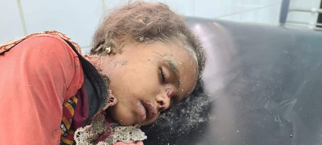 طفلة مصابة جراء قصف حوثي على حي الروضة بمدينة مأرب 