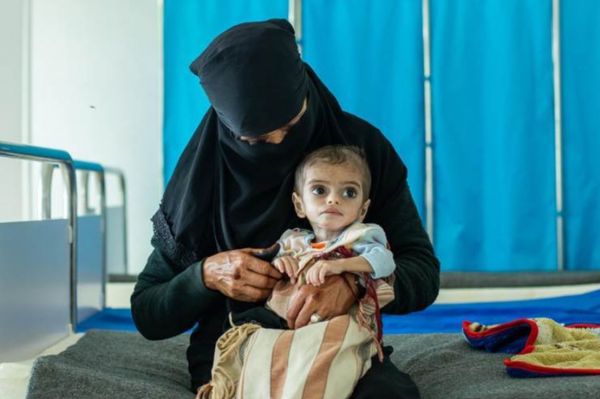 الأمم المتحدة: سوء التغذية تهديد دائم لأطفال اليمن