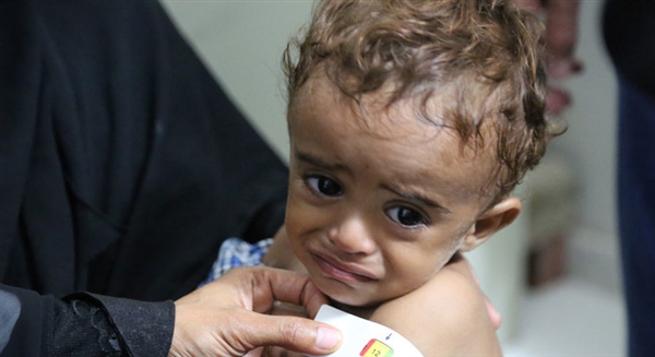 الصحة العالمية : 3 من بين كل 4 أطفال باليمن يعانون من سوء التغذية